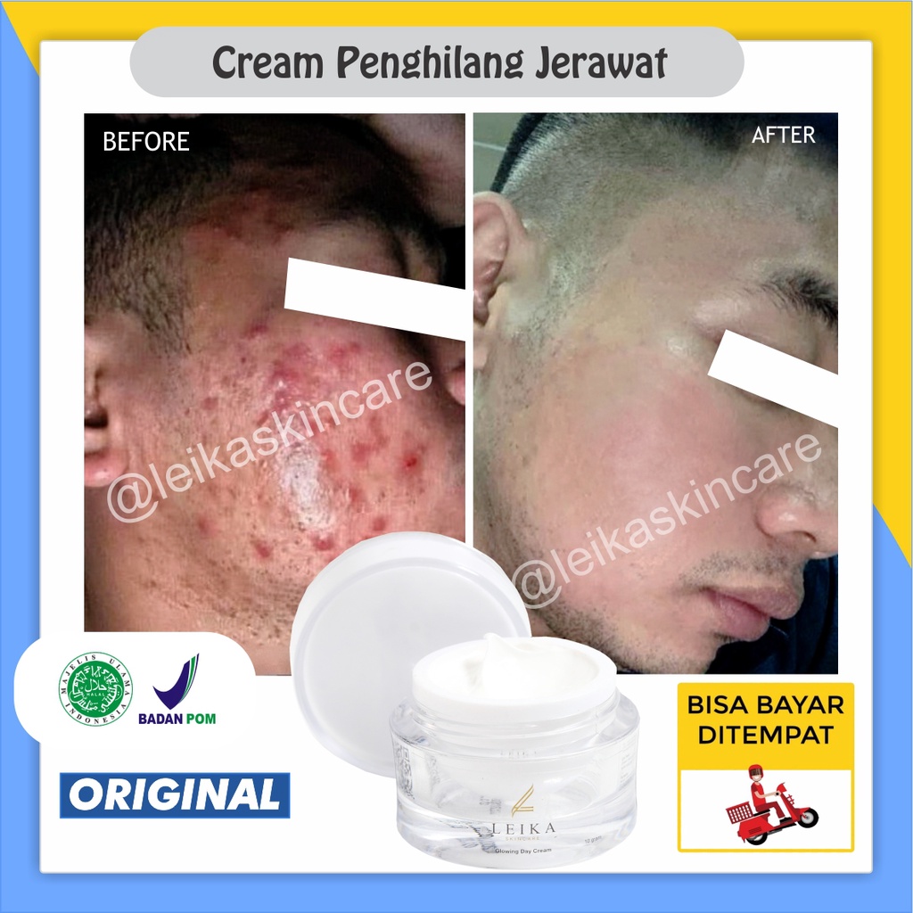 Krim Penghilang Jerawat Bopeng dan Bekas Jerawat Pria AMPUH Cream Jerawat Untuk Pria Penghilang Beka