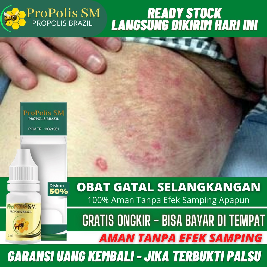 Obat Selangkangan Hitam Dan Gatal, Selangkangan Gatal Lecet Kering, Jamuran, Selangkangan Hitam Eksi