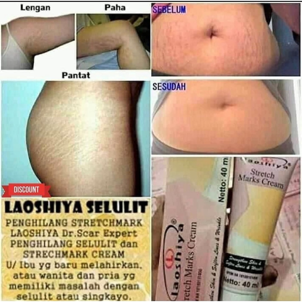 LAOSHIYA STRETCH MARKS CREAM ORIGINAL BPOM