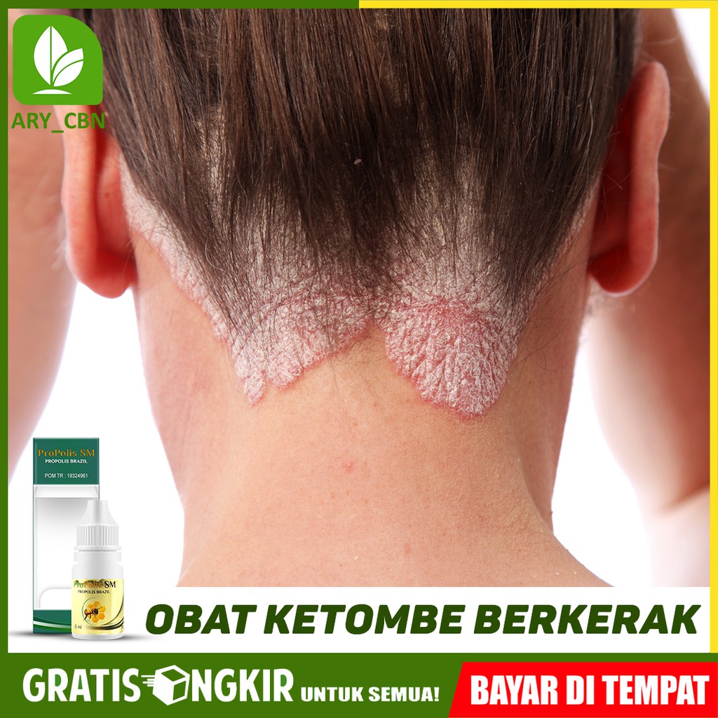 Obat Ketombe Berkerak, Ketombe Kering, Bersisik Kepala Herbal PROPOLIS SM Di Cirebon Bisa COD