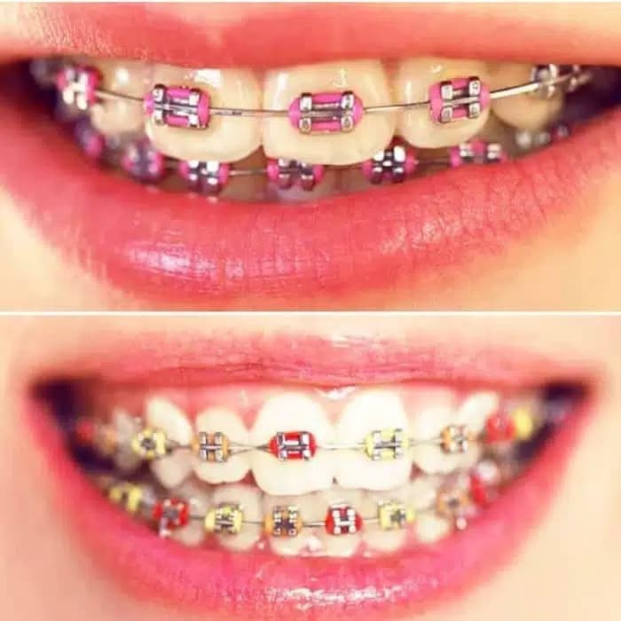 Behel Kawat Gigi Lepas Pasang Fashion Aneka Motif Cantik