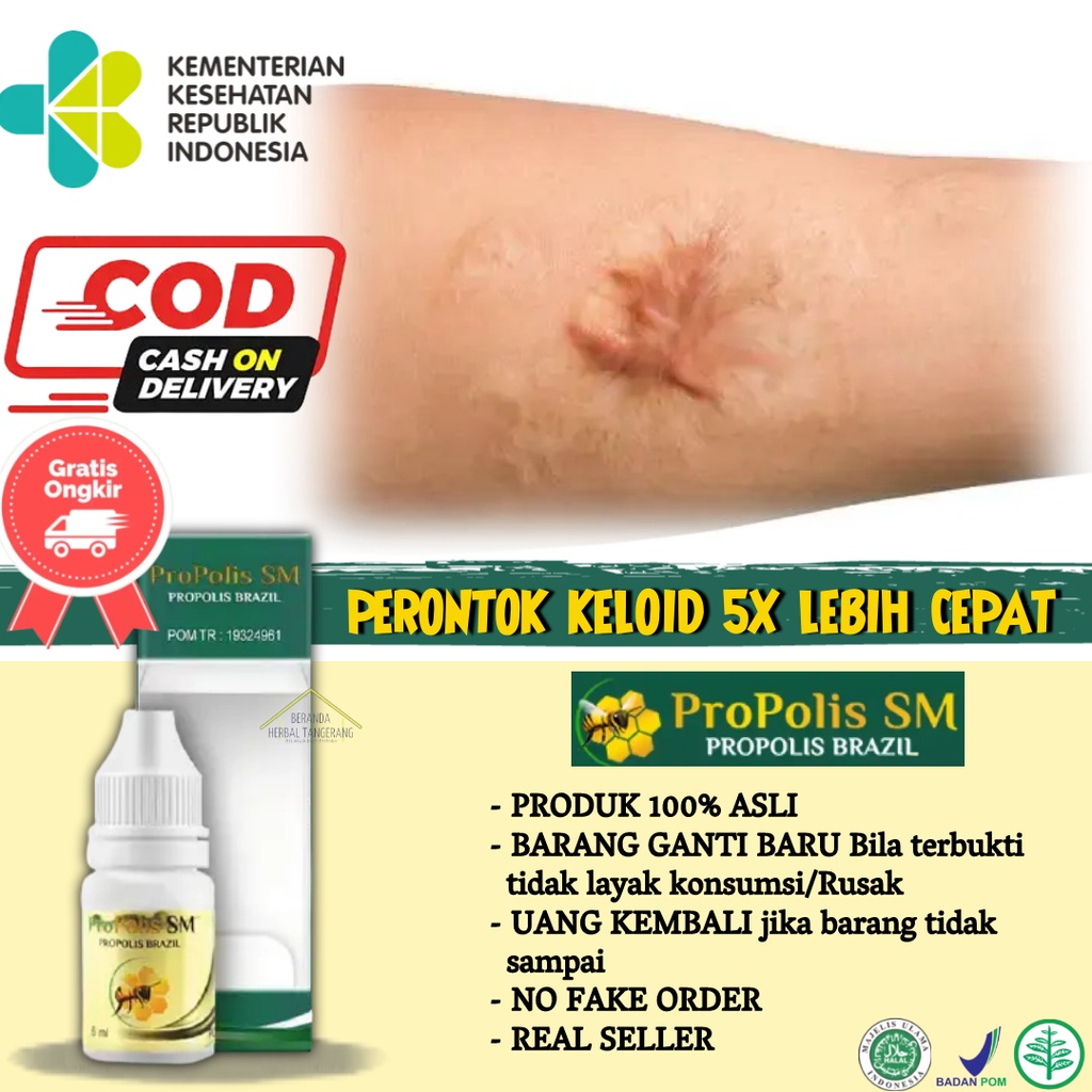 Jual Obat Keloid, Salep Perontok Keloid, Mengempiskan Keloid Luka Yang