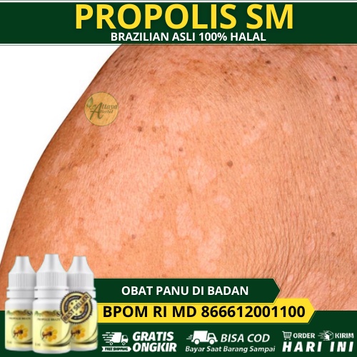 Obat Panu Di Badan, Di Wajah, Di Leher, Di Punggung, Obat Penghilang Hapuran   Di Badan, Menghilangk