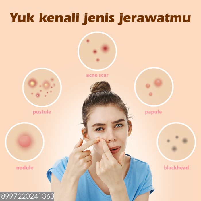 Whitelab WL Acne Cream tidak ada jerawat lagi