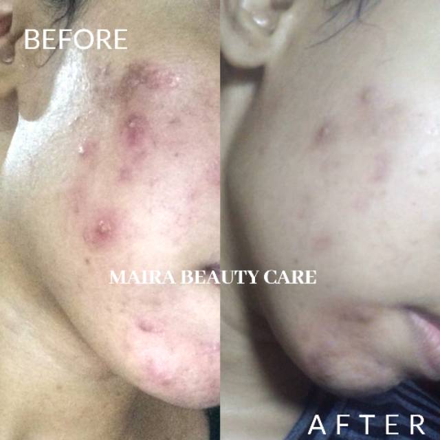 ACNE BRIGHT DOUBLE ACTION SERIES-2