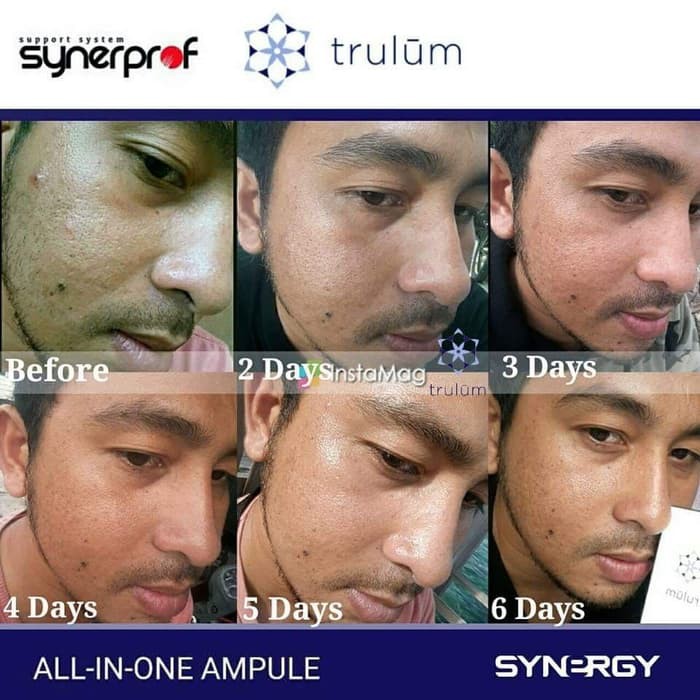 Trulum 15ml 5ml 120ml Bedak Penghilang Flek Hitam