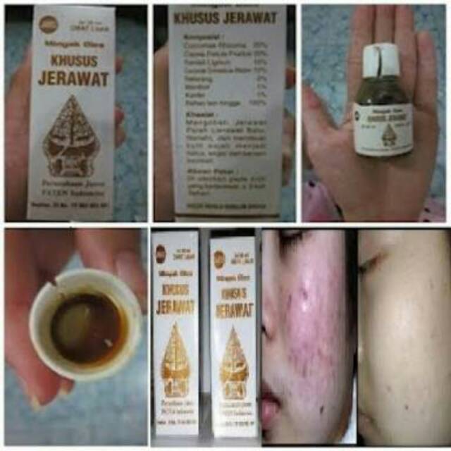 MINYAK OLES OBAT JERAWAT CAP WAYANG ORIGINAL - OBAT JERAWAT PALING AMPUH