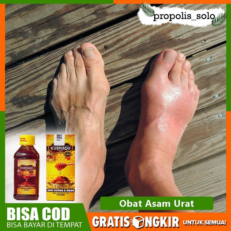 Obat Asam Urat Terlaris  - Asam Urat Dan Kolesterol Obat - Asam Urat Dan Rematik Sari Kurma