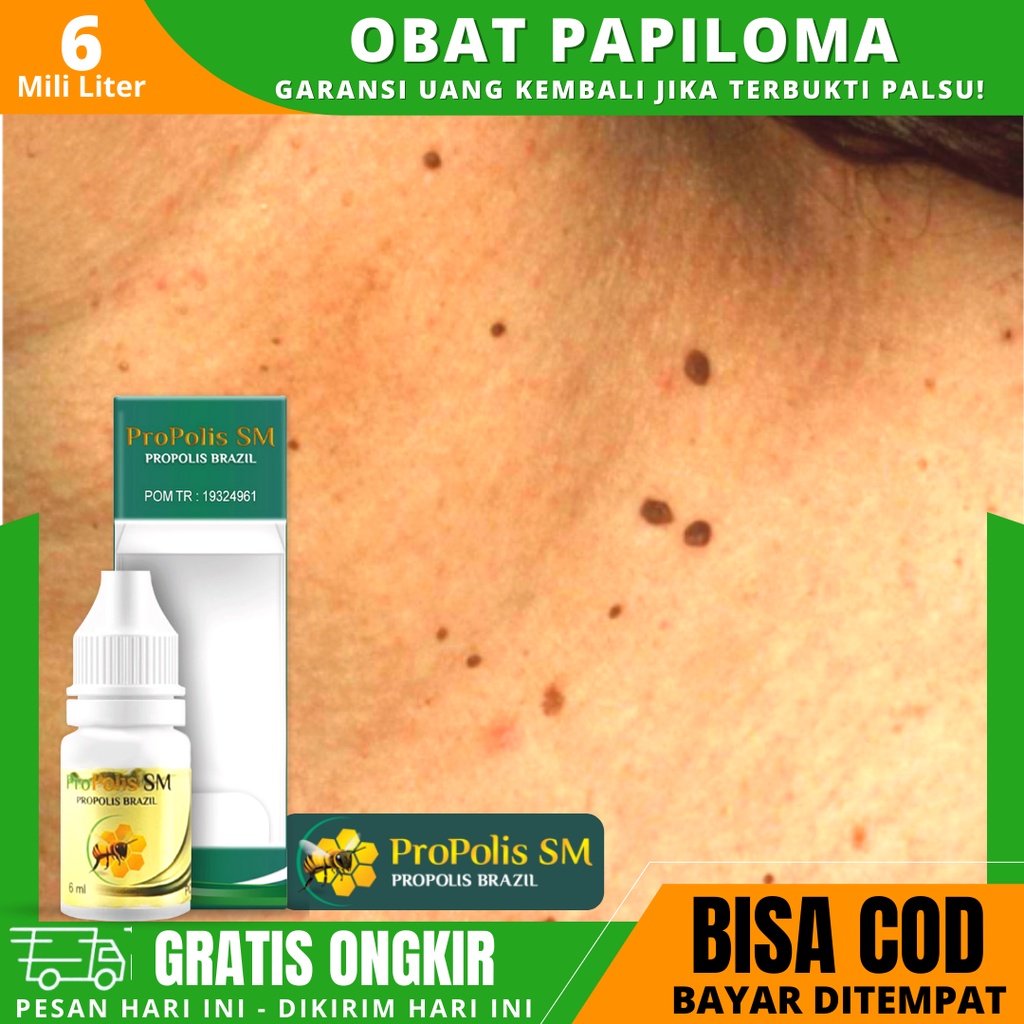 Obat Papiloma di Leher Wajah Mata, Obat Penghilang Kutil di Leher, Obat Kutil Papiloma | Propolis SM