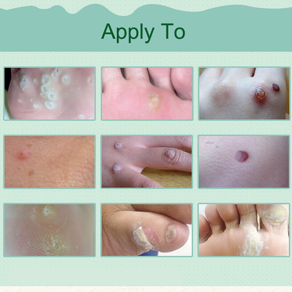 Obat kutil Obat mata ikan Cairan Anti KutilTangan Dan Kaki Menghilangkan Kutil &amp; Skin Tag Cairan Antibakteri Obat