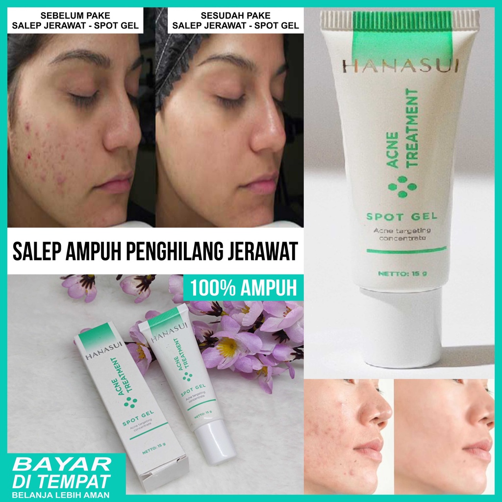 Salep Ampuh Penghilang Jerawat dan Bekas Jerawat