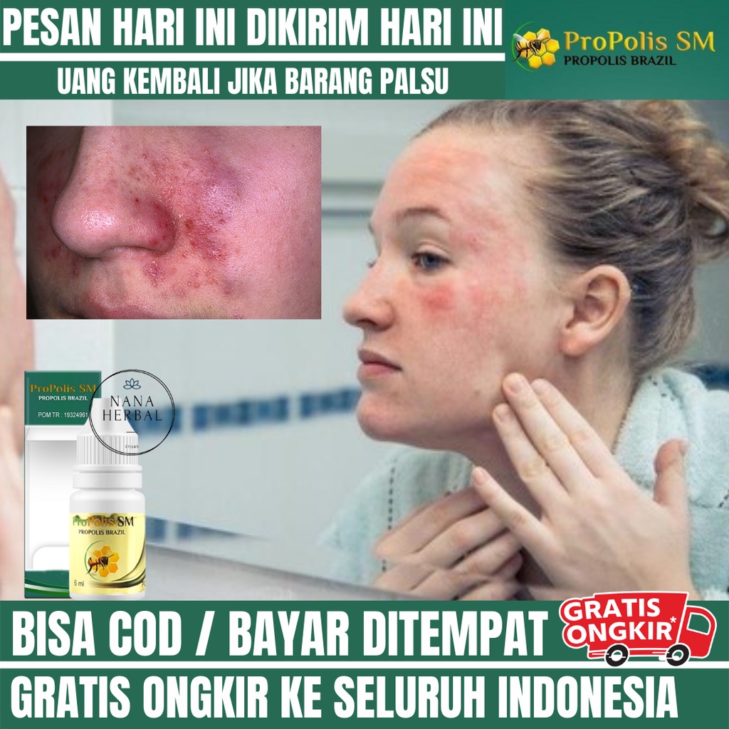 Obat Iritasi Kulit Wajah, Obat Iritasi Kulit, Obat Oles Kulit Perih karena Iritasi, Obat Kulit Gatal