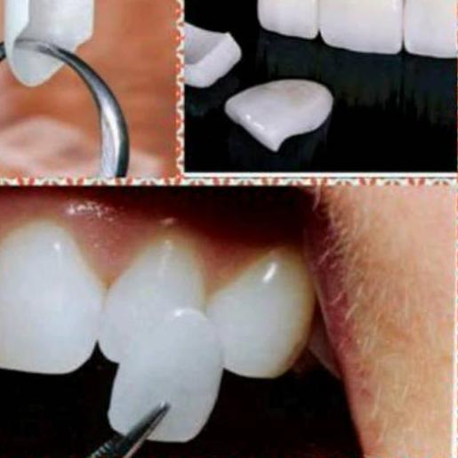 ✴ Teeth Veneer, Gigi Aplikasi, Gigi Kelinci. Vener ➵
