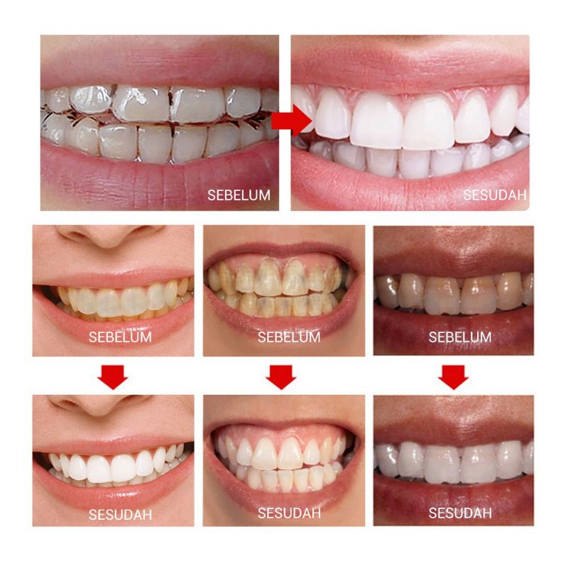 BREYLEE Pemutih Gigi Kuning Kerak Penghilang Karang Permanen Original Breylee Teeth Whitening