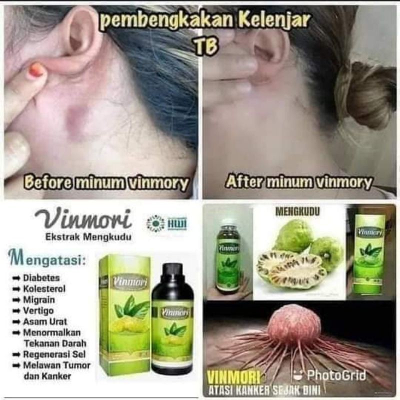 VINMORI MENGKUDU(PEMBENGKAKAN KELENJAR TB,DIABETES DLL)