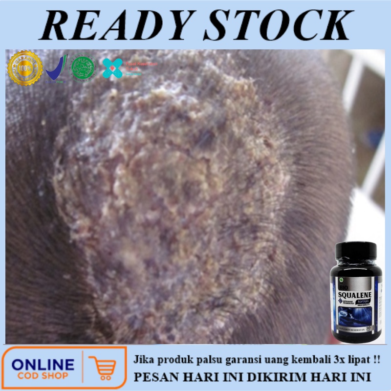 Obat Tinea Capitis / Kapitis, Obat jamur kulit kepala, Obat kulit kepala, Obat gatal jamur kulit, Ob