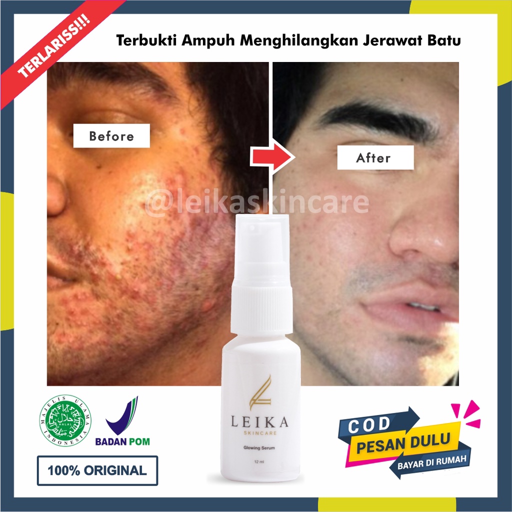 Serum Penghilang Jerawat Pria Aman Cepat BPOM Serum Jerawat Ampuh Permanen Serum Wajah Anti Acne Hal