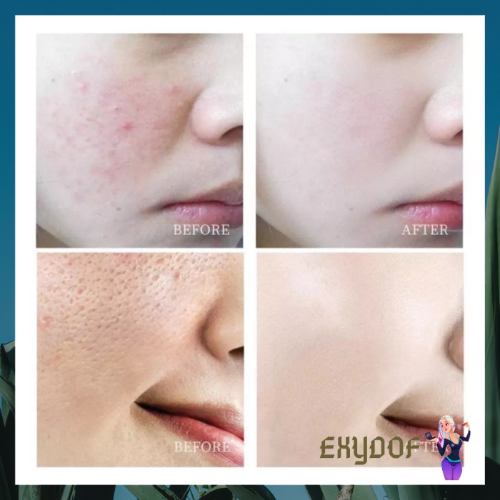 SALICYLIC ACID ICE CREAM MASK ORIGINAL  MASKER ES KRIM SALICYLIC ACID NEWDEAL