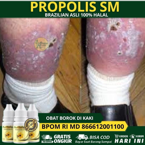 Obat Borok di kaki, Budug Di Kaki Anak, Borok bernanah, Salep pengering luka borok, Mengobati Borok 