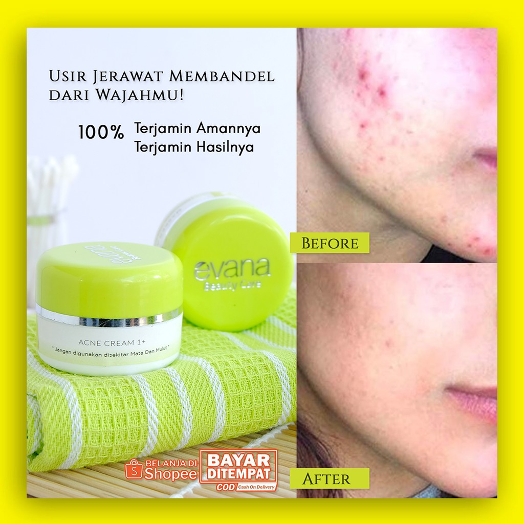 Wajib Konsul Acne Cream Evana Cream Penghilang Jerawat Paling Ampuh Nomer Satu Obat Jerwat Ringa Dan Meradang Shopee Indonesia