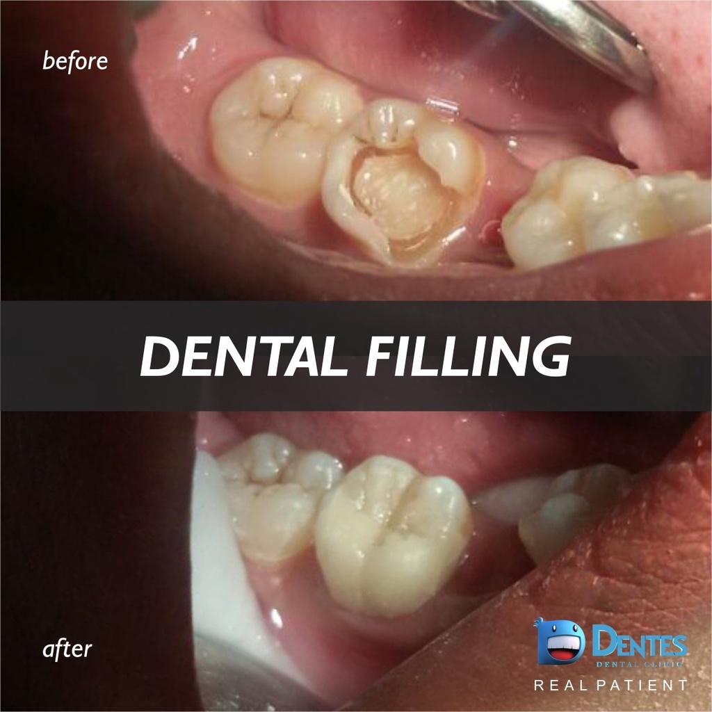 PERMANEN Gigi palsu penutup ompong ASLI 100% Penambal gigi ompong permanen / Gigi palsu penutup ompo