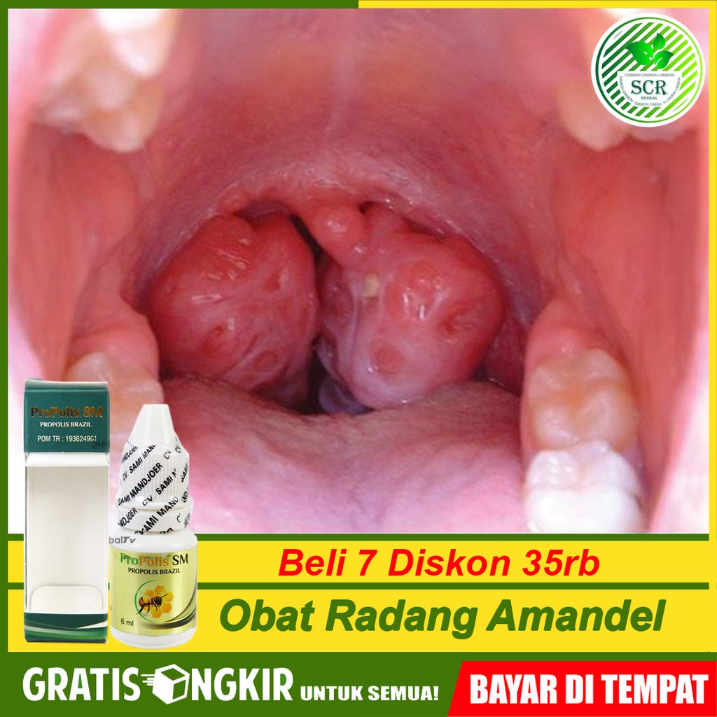 Obat Radang Amandel Tonsilitis Kronis Radang Sakit Tenggorokan Sulit Menelan Propolis Di Cirebon COD