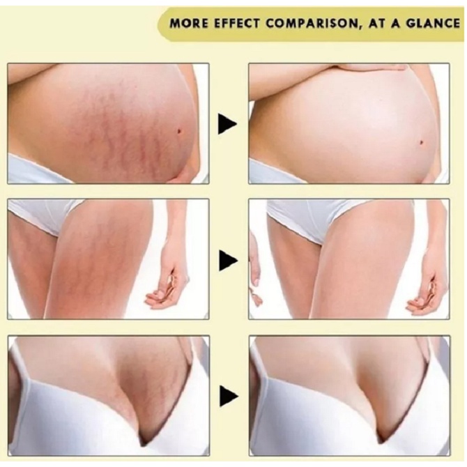 Stretch Mark Penghilang Kerutan Di Perut dan Kaki 7 Days