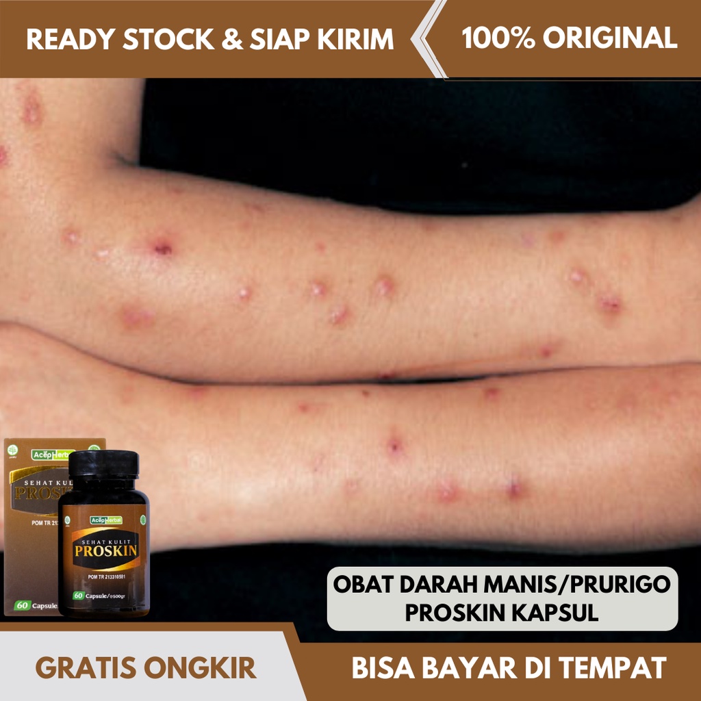Obat Koreng Prurigo, Obat Gatal Darah Manis ( Bertestimoni ), Obat Koreng Darah Manis, Obat Salep Da