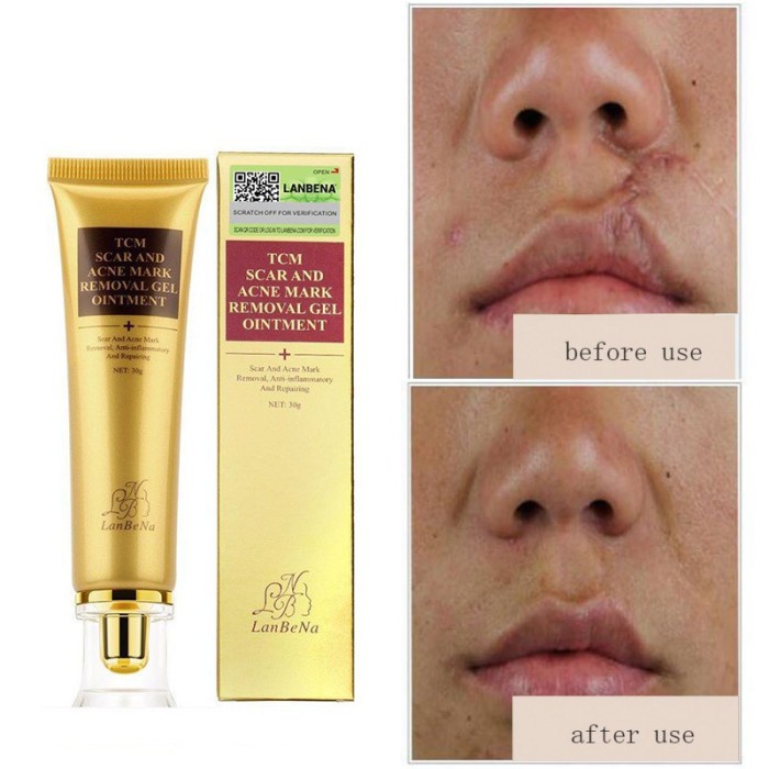 Krim Ampuh Menghilangkan Bekas Luka Bakar Bekas Operasi