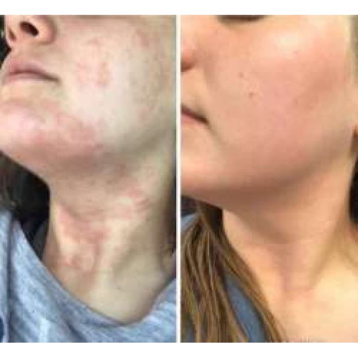 Cream Eksim dan Psoriasis Herbal Alami Ampuh