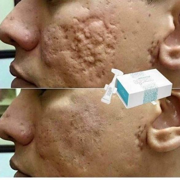 Instanly Ageless Penghilang Kantung Mata, Bekas Bopeng di Wajah