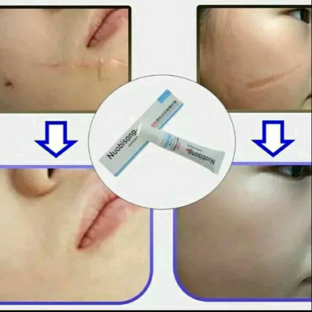 Nuobisong Krim Penghilang Bekas Luka - Bekas jerawat - flek hitam - bekas operasi