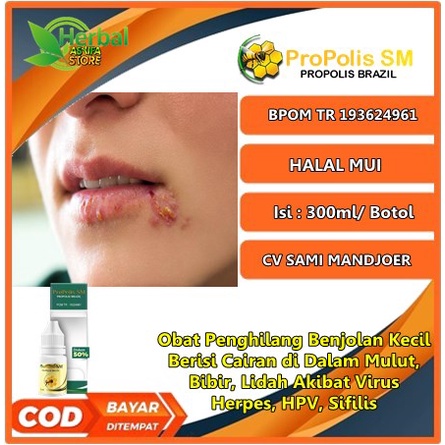 Obat Penghilang Benjolan Kecil Berisi Cairan di Dalam Mulut, Bibir, Lidah Akibat Virus Herpes, HPV, 