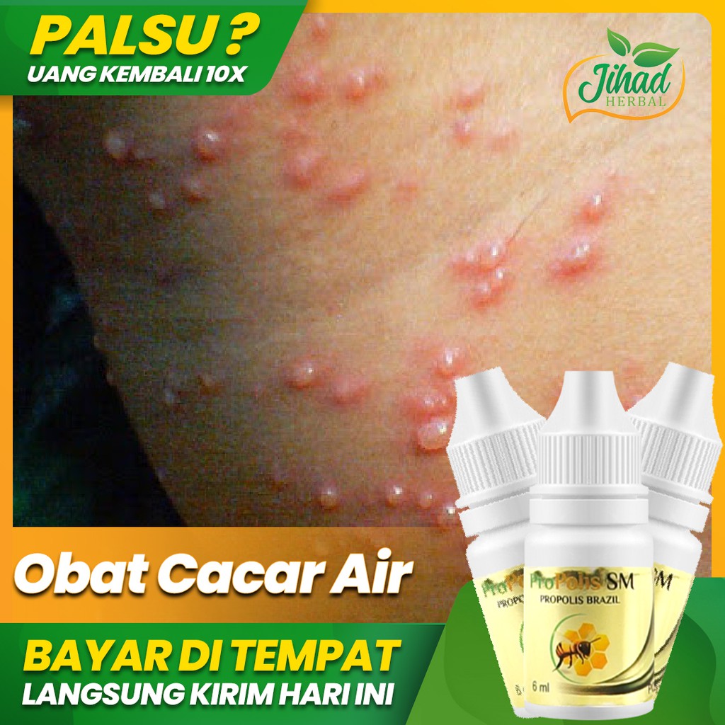 Obat Cacar Air, Cacar Api, Kulit Cacar, Campak, Herpes, Bekas Luka Cacar Propolis Aman Untuk Anak