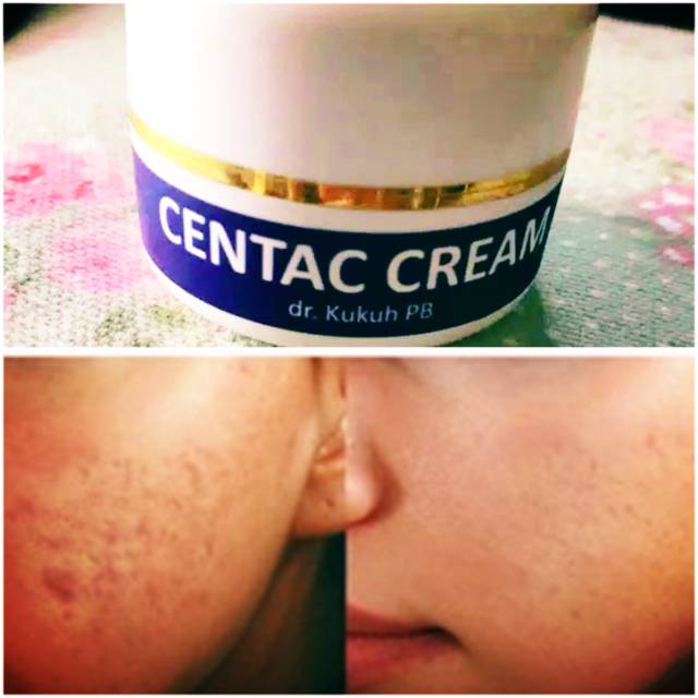 CENTAC CREAM  DR. KUKUH PB / KRIM UNTUK BOPENG-BOPENG / BEKAS JERAWAT