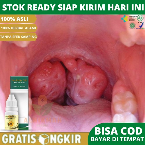 Obat Amandel, Obat Sakit Amandel, Obat Amandel Herbal, Obat Sakit Tenggorokan, Obat Sakit Tenggoroka