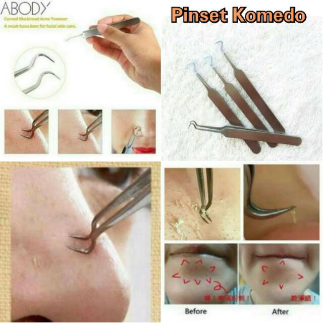 PINSET KOMEDO ALAT PENCETAN PENJEPIT JERAWAT PEMBERSIH BLACKHEAD - 1 PC