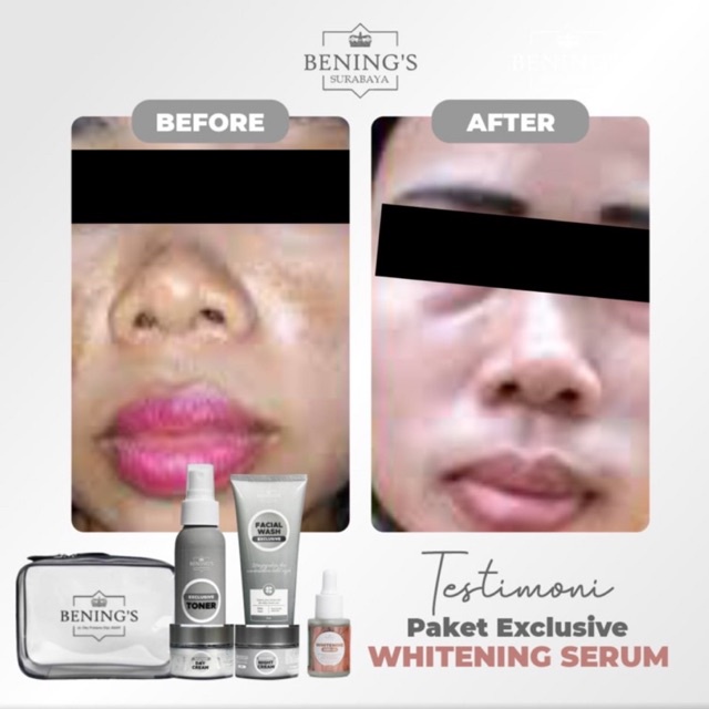 BENING'S PAKET EXCLUSIVE | MENGATASI FLEK, MELASMA &amp; MENCERAHKAN KULIT