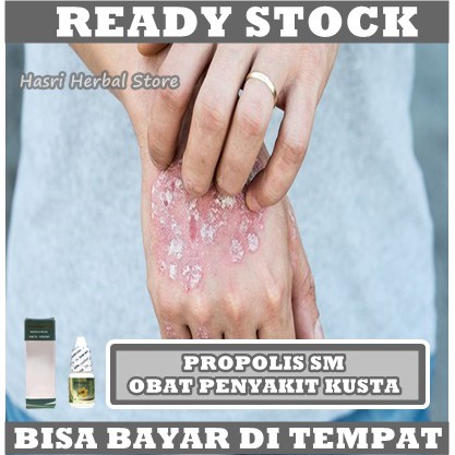 Obat Kusta, Obat Kusta Kering, Obat Kusta Basah, Obat Lepra, Obat Herbal Kusta, Obat Bercak Putih Di tangan, Obat infeksi Kulit, Mati Rasa, Eksim, Atasi Dengan Propolis SM 100% Herbal Alami BPOM