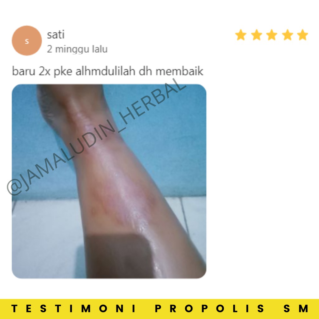 PROPOLIS SM - Obat Eksim Gatel Gatal Kulit Jamur Herbal - Obat Kulit Herbal - Obat Gatal - Obat Luka Diabetes - Obat Penyakit Kulit - Obat Exim - Obat Gatal Kulit - Obat Oles Bisul Jerawat Darah Kotor - Obat Salep Gatal Gatel Kulit Jamur Bakteri-7