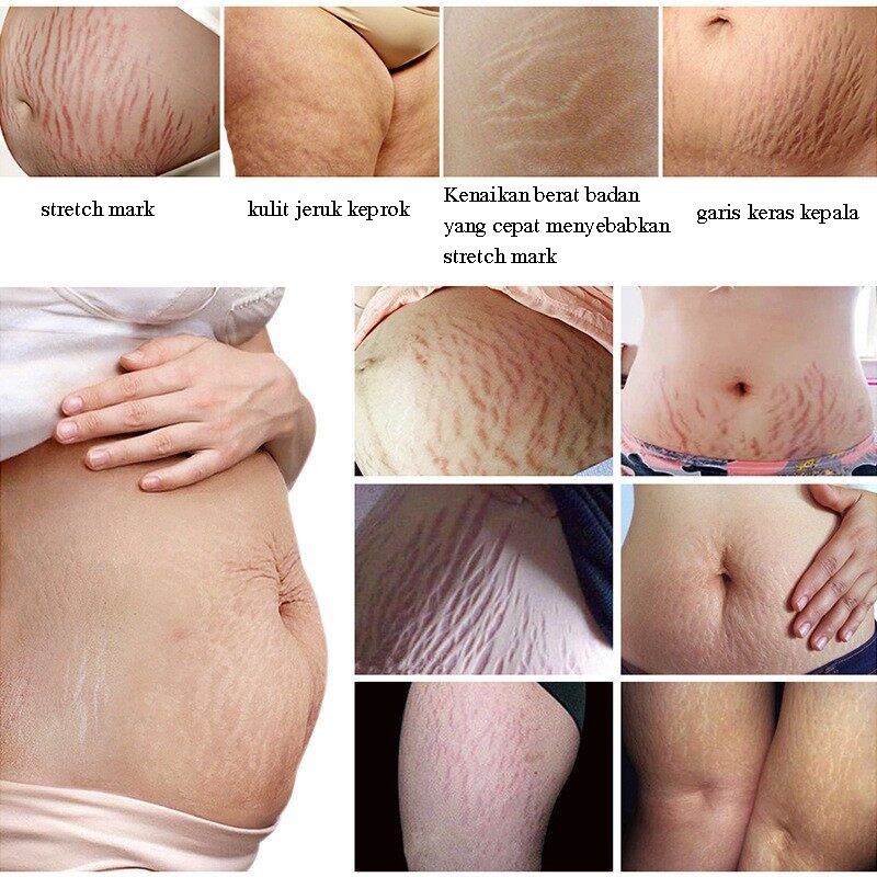 Stretch Mark Cream 45g / Penghilang Stretch Mark / Stretch Marks Pilihan Ibu / BPOM Penghilang Stretch Mark Ampuh / Mengencangkan kulit, mengembalikan kehalusan dan elastisitas