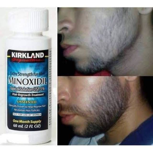 Minoxidil