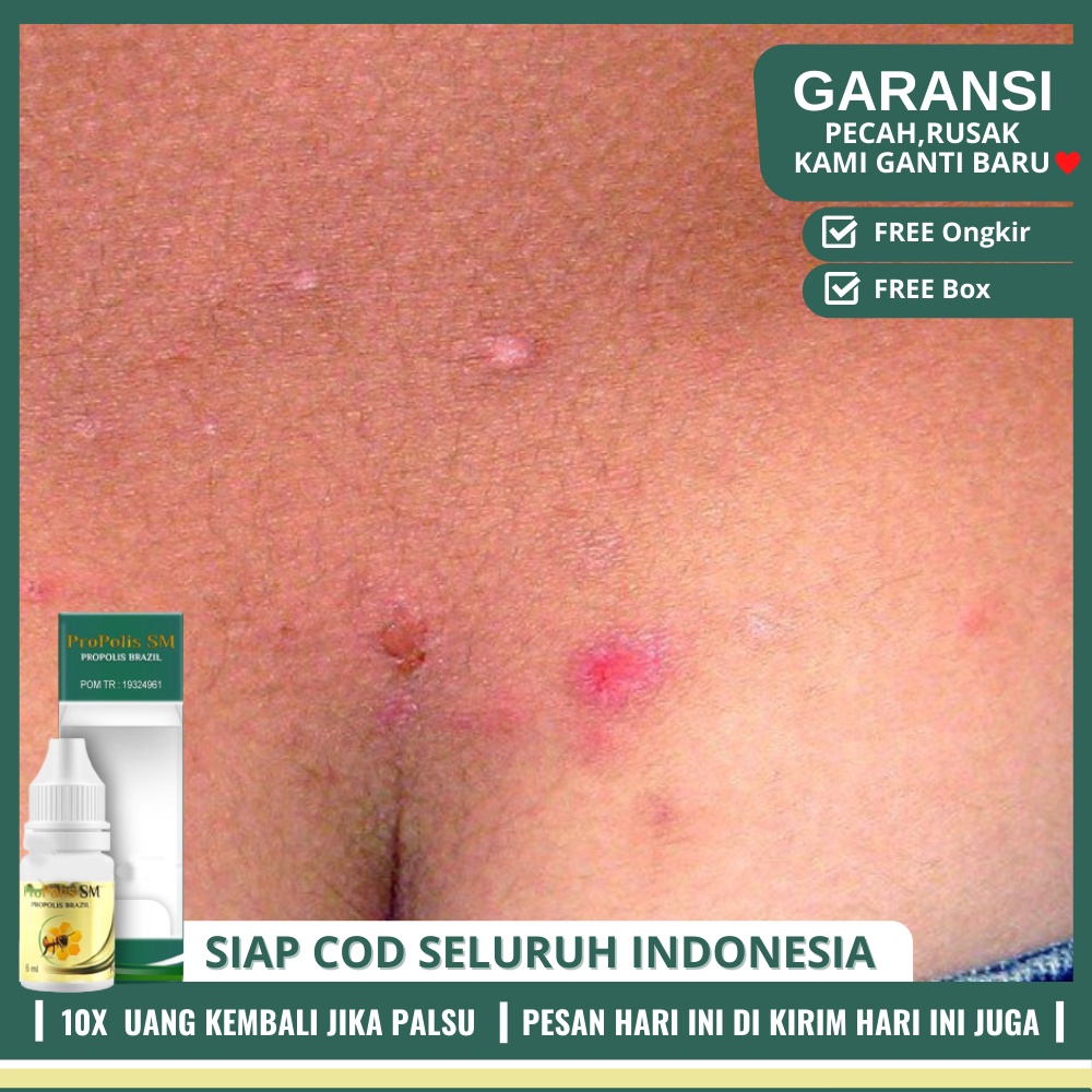 Obat Penghilang Gatal Di Bokong, Obat Gatal Jamur Kulit, Menyembuhkan Bentol2 Di Pantat - PROPOLIS