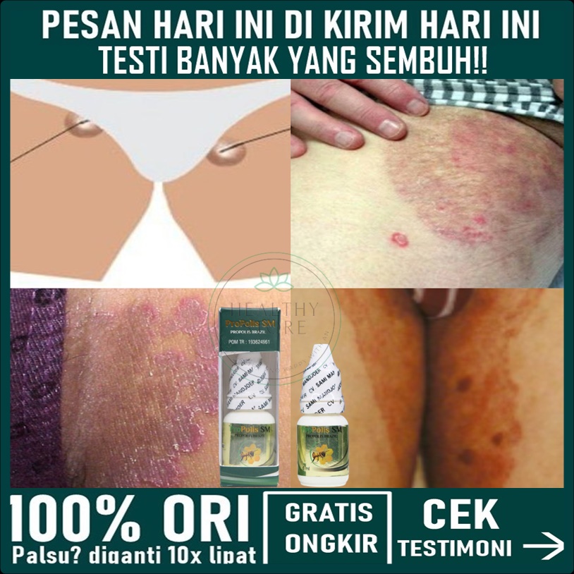 Obat Benjolan Di Selangkangan, Selangkangan Lecet , Obat Gatal Selangkangan, Penghancur Benjolan Sel