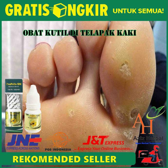 Obat Kutil Di Telapak Kaki Obat Kutil Di Tangan Leher Dahi Propolis Shopee Indonesia