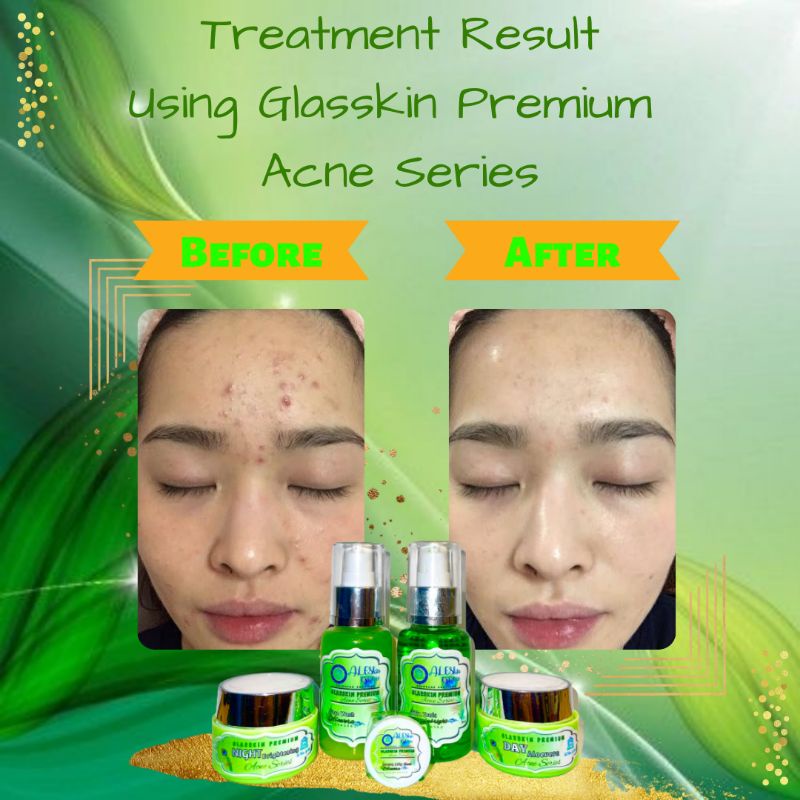 ACNE SERIES GLASSKIN PREMIUM SKINCARE PERAWATAN PEMUTIH WAJAH GLOWING JERAWAT FLEK ALESKIN GLOW