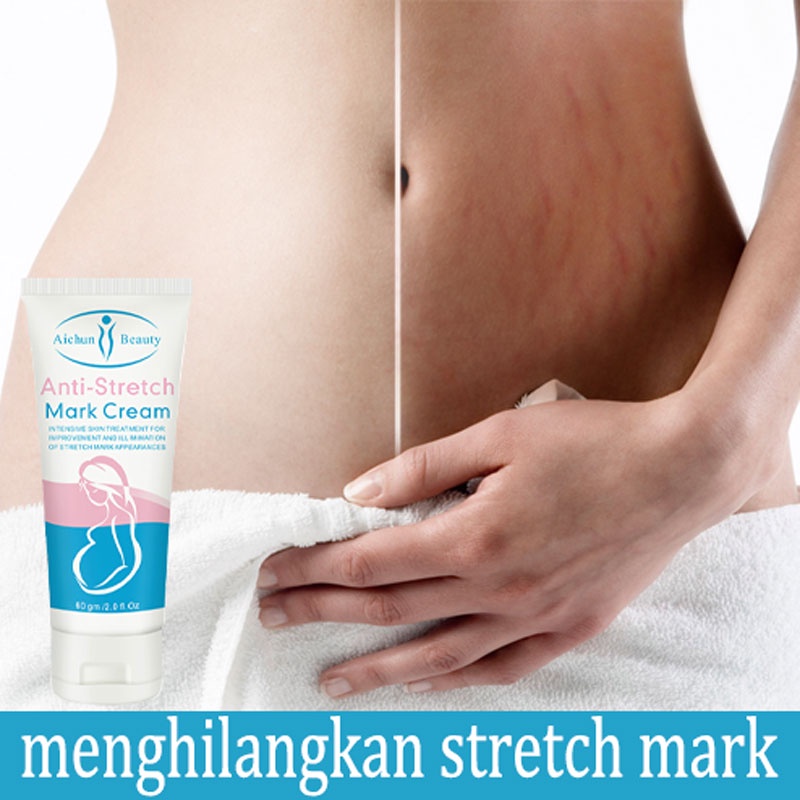 Anti Stretch Mark Cream AICHUN BEAUTY Stretch Mark Removal Bekas Luka Perbaikan Cream Stretch Mark Removal Perawatan Bekas Luka 60g body lotion, pelembab kulit, menghidrasi dan mengangkat