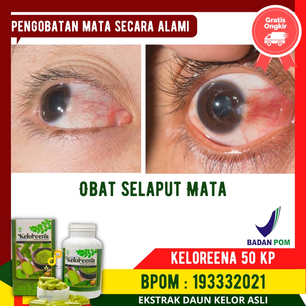 Obat Selaput Mata - Menghilangkan Selaput Mata - Mata Silinder - Rabun Jauh/Dekat - Kesehatan Mata a