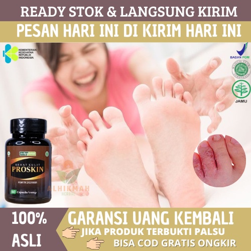 Obat Gatal Berair, Obat Kutu Air, Obat Kuman Air, Obat Kutu Air Untuk Tangan, Obat Kutu Air Untuk Ka