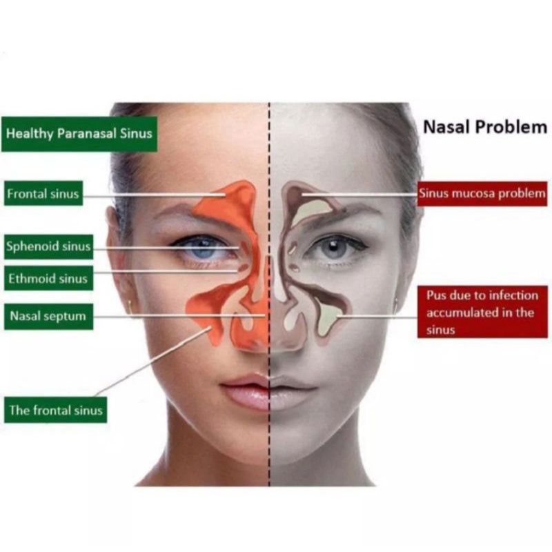 Semprotan Hidung Untuk Membantu Meringankan Sinusitis Rhinitis Pilek / Obat Sinusitis / Semprotan Nasal 20ml T